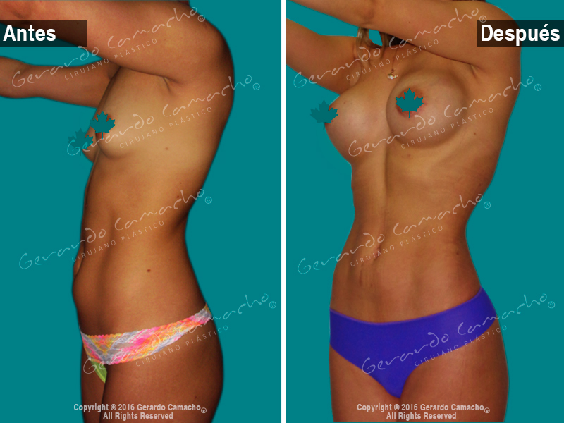 Testimonio lipolisis vaser Gerardo Camacho